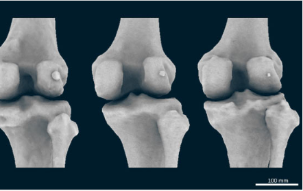人类正在失去与骨关节炎相关的膝骨 现在正在卷土重来