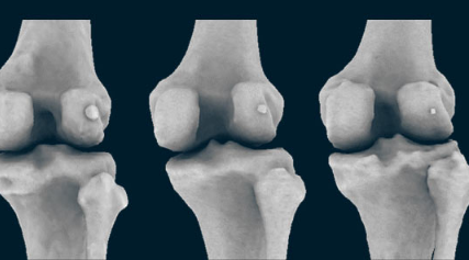 人类正在失去与骨关节炎相关的膝骨 现在正在卷土重来