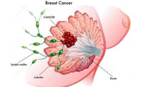 研究人员发现治疗ER +乳腺癌的机会错失