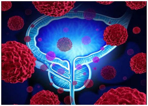 前列腺癌的常见遗传缺陷与预后不良有关