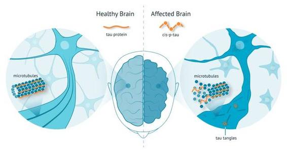 脑成像将阿尔茨海默氏症的下降与tau蛋白联系起来