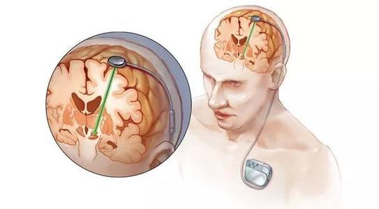 研究人员针对性的深部脑刺激治疗强迫症