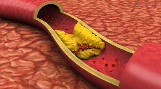 确定了动脉硬化的原因以及潜在的治疗方法