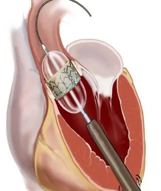 痴呆患者主动脉瓣置换的趋势