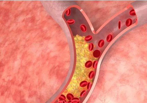 高血脂使细胞分担压力