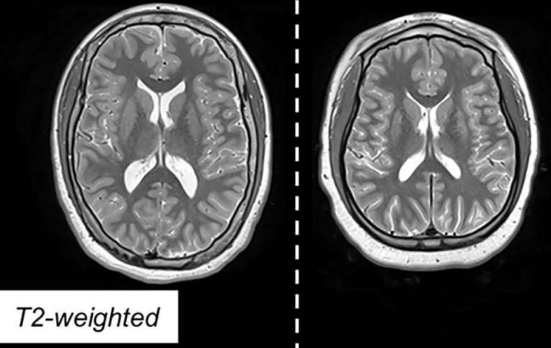 MRI 识别早产儿脑发育不典型的标志物