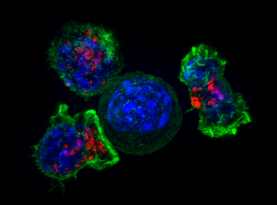 研究团队发现实体瘤中 CAR T 细胞的新靶点