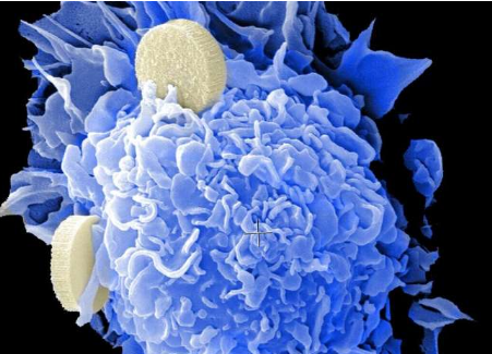 研究人员阐明了肾母细胞瘤的遗传机制