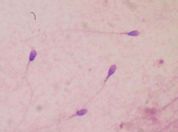 冷冻精子与新鲜精子一样有效用于授精治疗