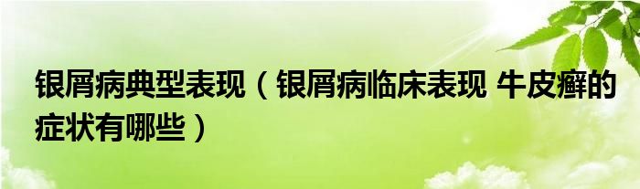 银屑病典型表现（银屑病临床表现 牛皮癣的症状有哪些）