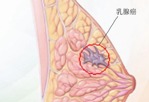 由遗传主开关控制的乳腺癌